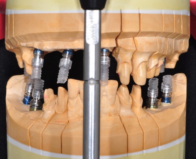 全顎的インプラント技工について