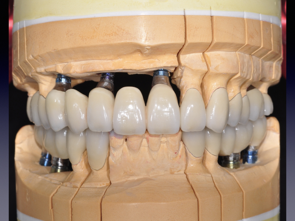 全顎的インプラント技工について