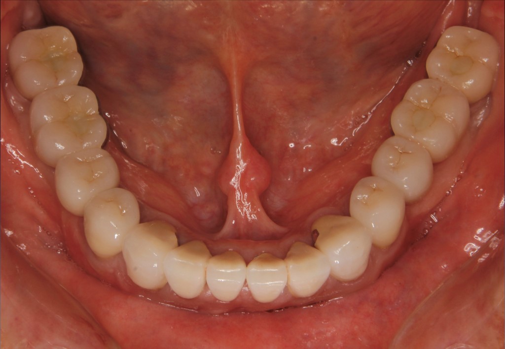 全顎的インプラント技工について