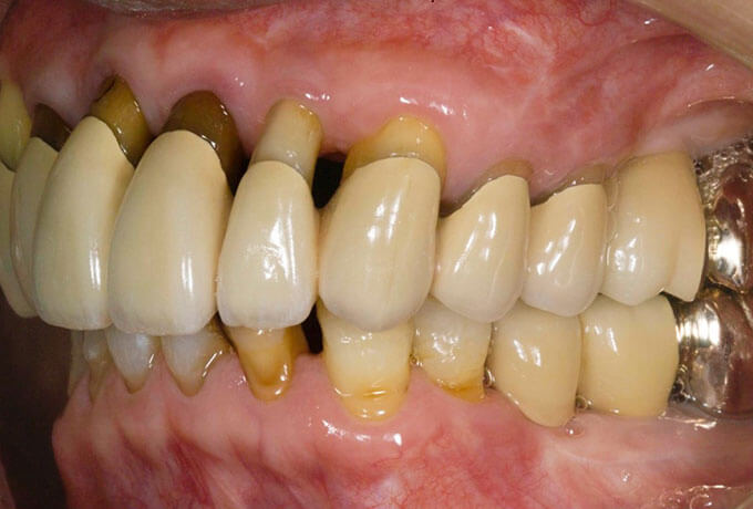 PERIODONTAL PROSTHESIS